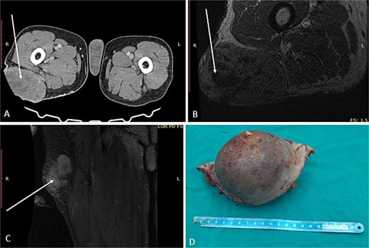 First surgical treatment. (A) CT, (B and C) MRI, (D) surgical specimen.
