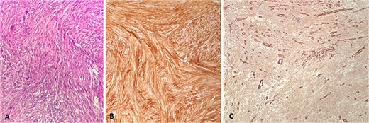 Second metastasis from high grade soft tissue sarcoma. (A) HE ×200, (B) CD10 ×200, (C) SMA ×100.