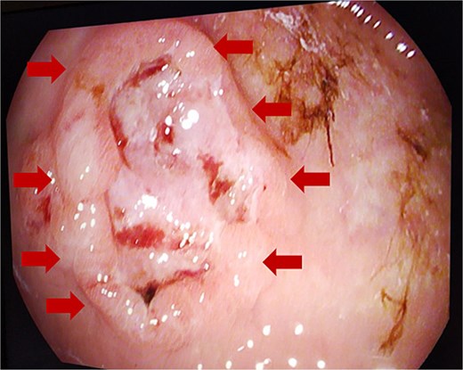 Endoscopic gastric ulcerative lesion.