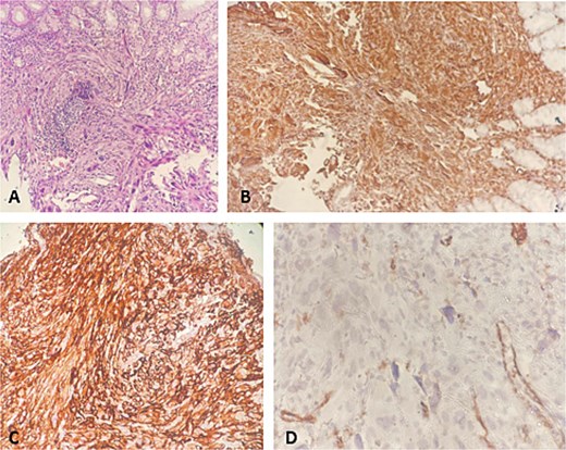 Gastric biopsy. (A) HE ×200; (B) vimentin ×200; (C) CD10 ×200; (D) SMA ×200.