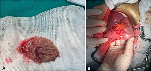 Gastric surgery. (A) Wedge gastric resection; (B) suture after gastric resection.