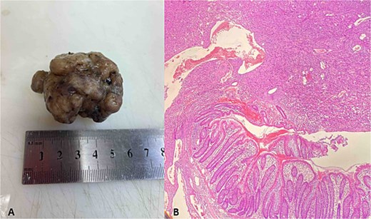 Polypoid metastasis in right colon. (A) Gross specimen; (B) HE×100.