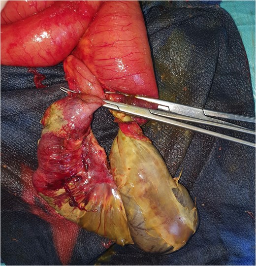 Necrotic ileal segment following mesenteric contusion.