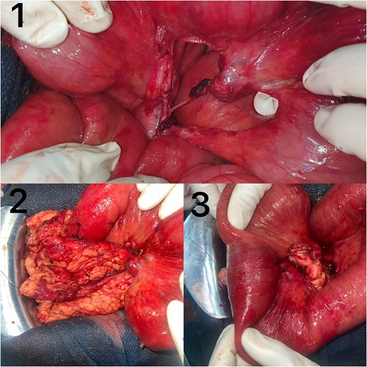 (1) Mesenteric contusion with a preserved nourishing vessel ensuring a viable ileal segment. (2) Anterior view of the omental coverage of the nourishing vessel. (3) Posterior view of the omental coverage of the nourishing vessel, also fixed to the posterior mesenteric border of the ileum.