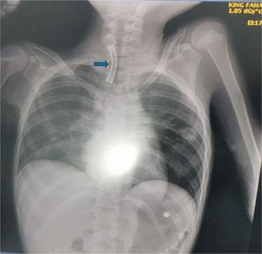 This figure demonstrates the patient chest X-ray showing the radio-opaque cannula in the right main bronchus (arrow).