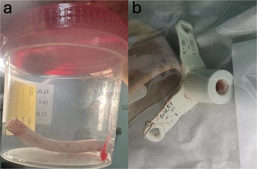 (a) Demonstrates the slipped part of the tracheostomy tube which was extracted from the right main bronchus. (b) Shows the outer and the remaining part of the tracheostomy tube that was broken.