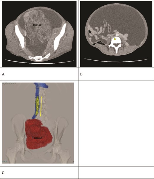 Preoperative contrast-enhanced CT. (A) A right ovarian tumor is observed in the pelvic cavity. (B) Massive ascites and a thrombus (arrow) in the IVC are observed. (C) The 3D reconstruction image shows a venous thrombus (arrow) extending from the right iliac vein to the IVC at the L2 level. The distance between the renal vein and the thrombus tip is only 25 mm.