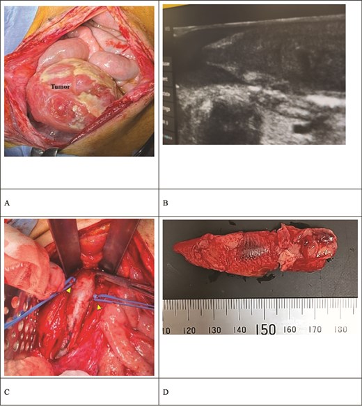 Intraoperative findings. (A) The ovarian tumor did not adhere to the peritoneal cavity. (B) Intraoperative ultrasound revealed a thrombus extending to the IVC below the renal vein. The thrombus had high echogenicity at the periphery and low echogenicity internally. (C) The IVC was clamped below the renal vein. The bilateral ovarian veins were ligated with vessel loops (arrow). (D) The extracted thrombus measured 65 × 15 mm and was already organized.