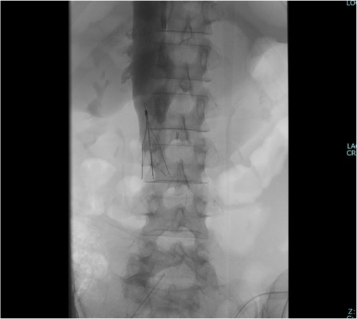 The IVC filter was placed after closing the abdomen.