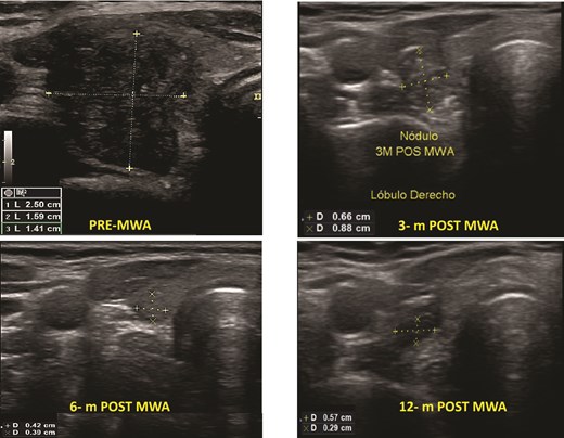 Benign thyroid nodules pre- and post-MWA (3, 6, and 12 months), see the changes in volume and the ultrasound aspect of the nodule.