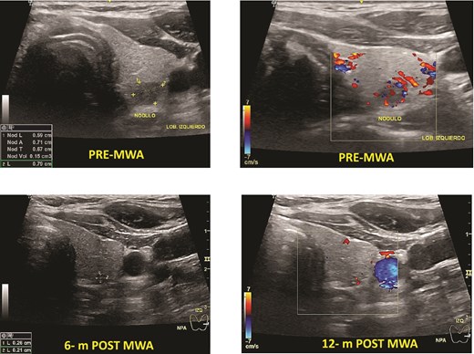 Papillary thyroid microcarcinoma pre- and post-MWA (6 and 12 months). Note that the nodule’s vanishing, making it hard to identify it by ultrasound.