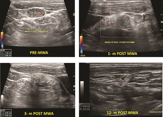 Cervical lymph node PTC metastasis pre- and post-MWA (1, 3, and 12 months).