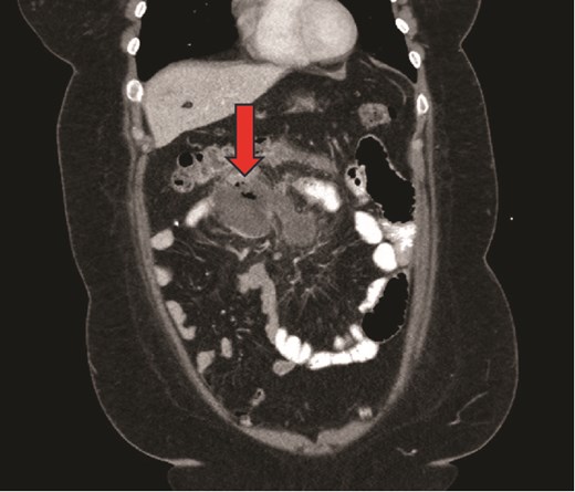 CT scan image of mesenteric abscess.