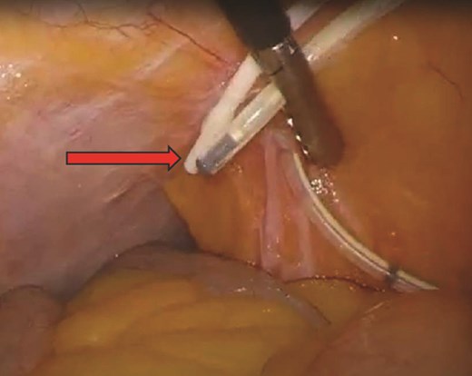 Intraabdominal portion of VP shunts.