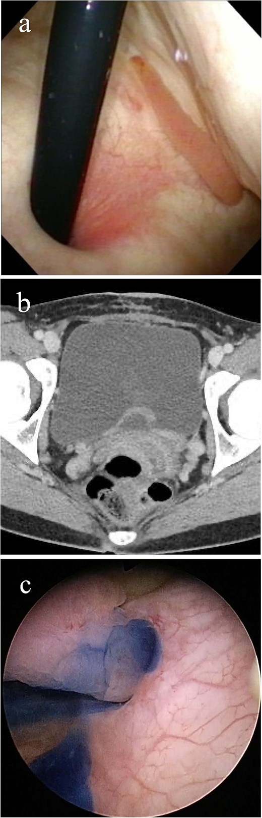 Imaging study findings. (a) Cystoscopy finding. Cystoscopy revealed that a tumor protruded from the left ureteral orifice into the bladder lumen, showing serpentine locomotion with respiratory movements. (b) Contrast enhanced computed tomography finding. Soft tissue shadow was detected around the left ureteral orifice, revealing a long thin tumor. (c) Indigo carmine was excreted through the left orifice that is occupied by the tumor.