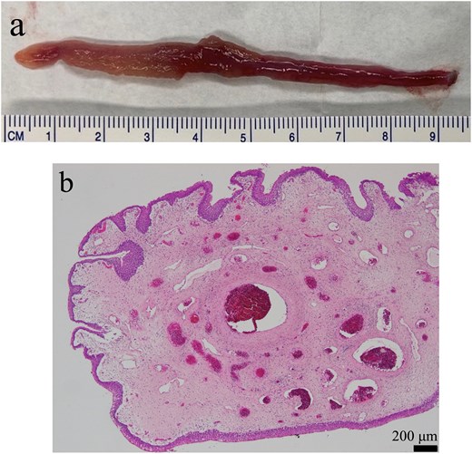 Findings from the excised specimen. (a) Macroscopic finding. The length of the tumor was 9.5 cm. (b) Microscopic finding (×10). A polyp with edematous stroma. The surface layer of the polyp was coated with atypical urothelial cells.