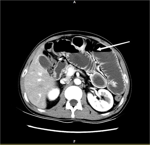 CT demonstrates features of intestinal obstruction as marked by the white arrow.