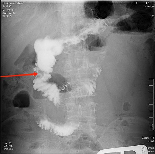 The contrast study reveals a complete obstruction at the terminal ileum, as indicated by the arrow.