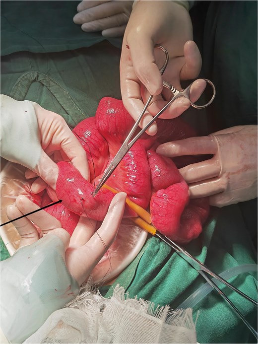 Localization of the calculus during surgery.
