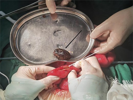 The black arrow indicates the gastric bezoar, and the white arrow marks the site of stone extraction.