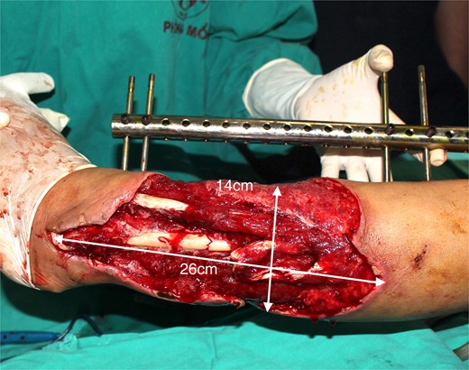 Patient 1. A 49-year-old female. Complex injury of the lower two-thirds of the right leg.
