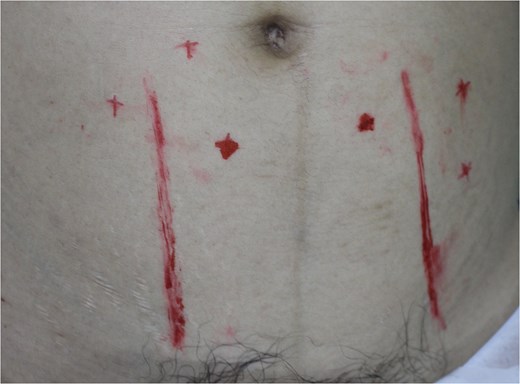 The perforators preoperatively were marked with a hand-held Doppler.