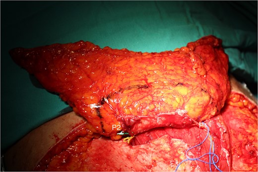 The DIEP flap with the size of 14 × 26 cm was dissected with two perforators (P1 and P2), and the rectus abdominis muscle fascia connecting the two perforators (F) was retained within.