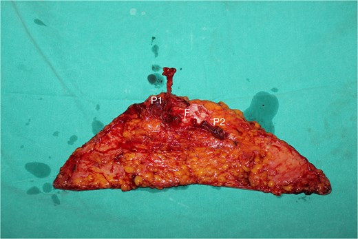 The flap was thinned and removed from the donor site to cover the defect.