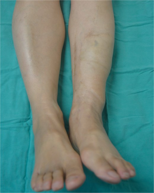 Results after 6 years, front view.