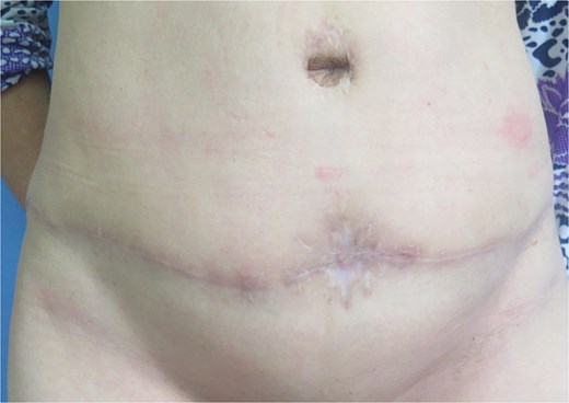 The donor site result after 6 years.