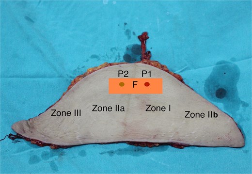 The perfusion zones in the flap with the fascial strip (P1: The pedicle’s perforator; P2: Perforator in the contralateral side, was ligated; F: The inter perforator fascia with 4 × 12 cm size).