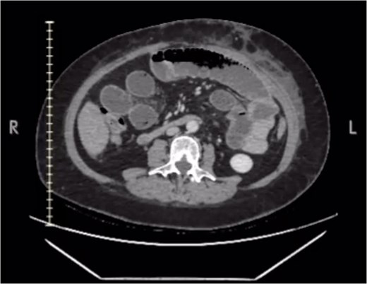 Contrast enhanced CT scan. Small bowel dilation.