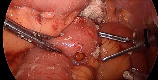 Diagnostic laparoscopy. Undigested solid food, seed.