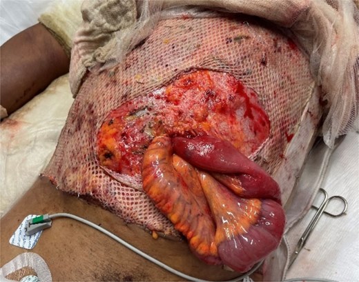 Acute evisceration of small bowel noted in the burn intensive care unit following an episode of coughing secondary to ventilator dyssynchrony.