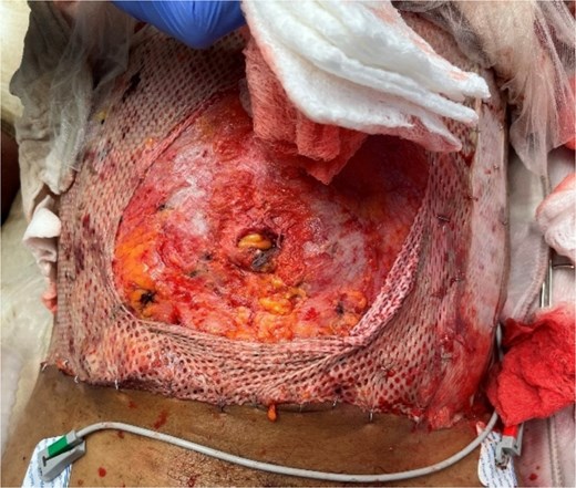 1.8 cm supraumbilical fascial defect noted in the operating room following reduction of the eviscerated small bowel.