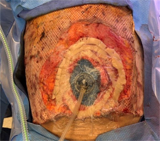 Concentrically applied ostomy/barrier rings that were secured to the anterior abdominal wall fascia in order to allow for sealing of the wound vac.