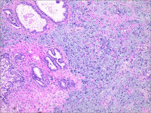 Histopathological examination revealed extensive infiltration of signet-ring cells, with the cytoplasm filled with mucinous vacuoles, and the nuclei showing eccentric positioning and dark staining. H&E stain 40×.