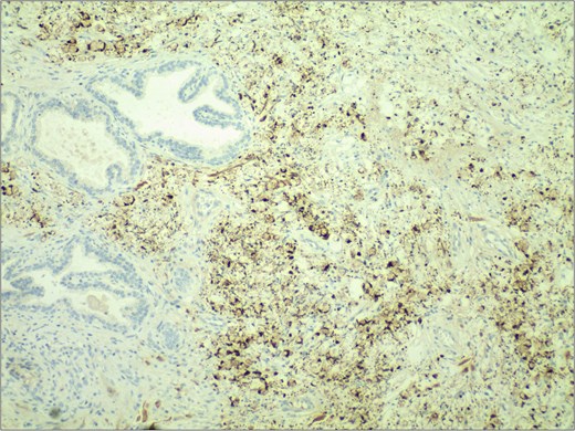 Immunohistochemical staining demonstrated strong positivity (++) for villin in the cytoplasm and cell membrane of tumor cells. IHC stain 40×.