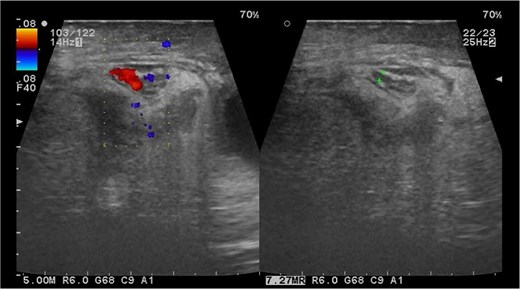 Testicular ultrasound with intestinal loops.