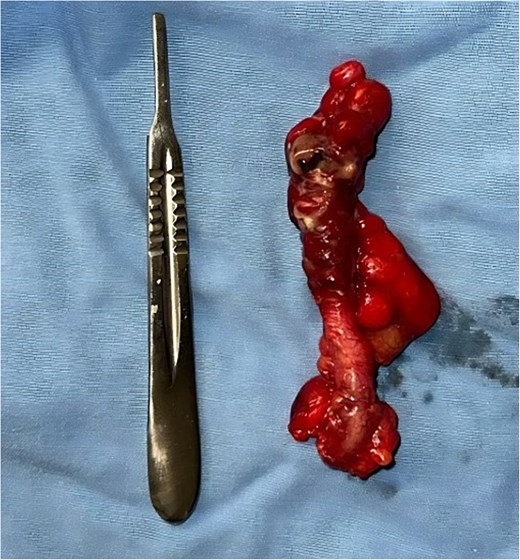 Appendectomy grade IV; perforation data, comparison with No. 3 scalpel.