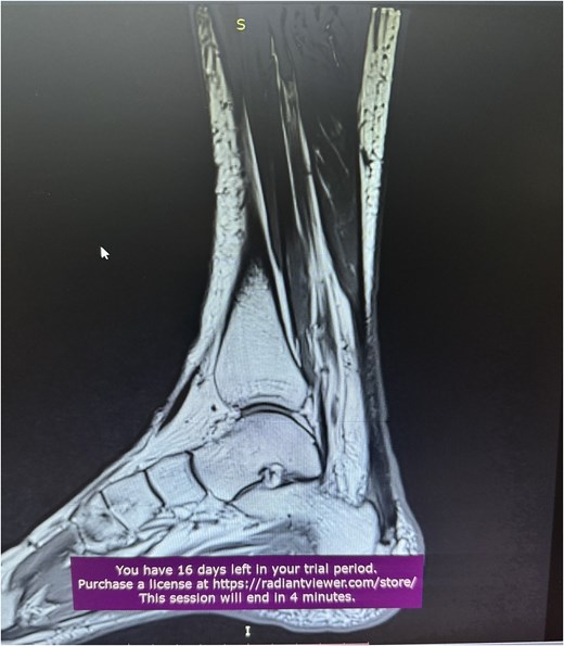 MRI of Achilles tendinopathy.