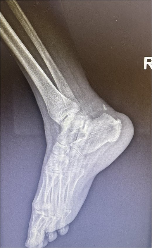 X-ray of Achilles tendon rupture with bone avulsion.