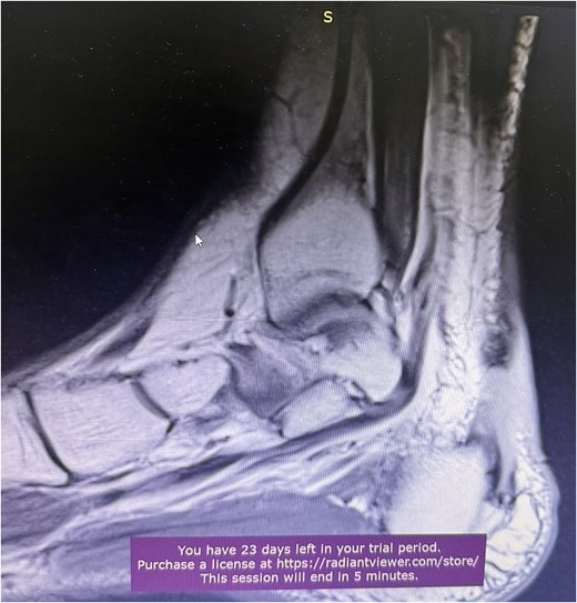 MRI of Achilles tendon rupture.