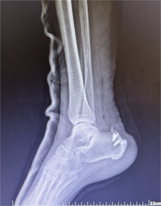X-ray postoperatively with suture anchors.