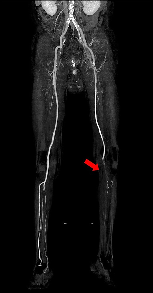 Preoperative 3D reconstructed contrast-enhanced CT. No contrast effect is seen in the blood flow of the lower leg.