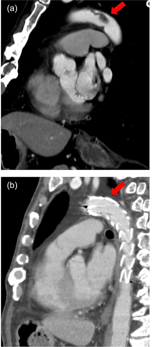 Sagittal view of contrast-enhanced CT. (a) Preoperative. A pedunculated intra-aortic thrombus is attached to the distal arch. (b) Postoperative. Thoracic stent graft is implanted in the distal arch with successful exclusion of the aortic thrombus.