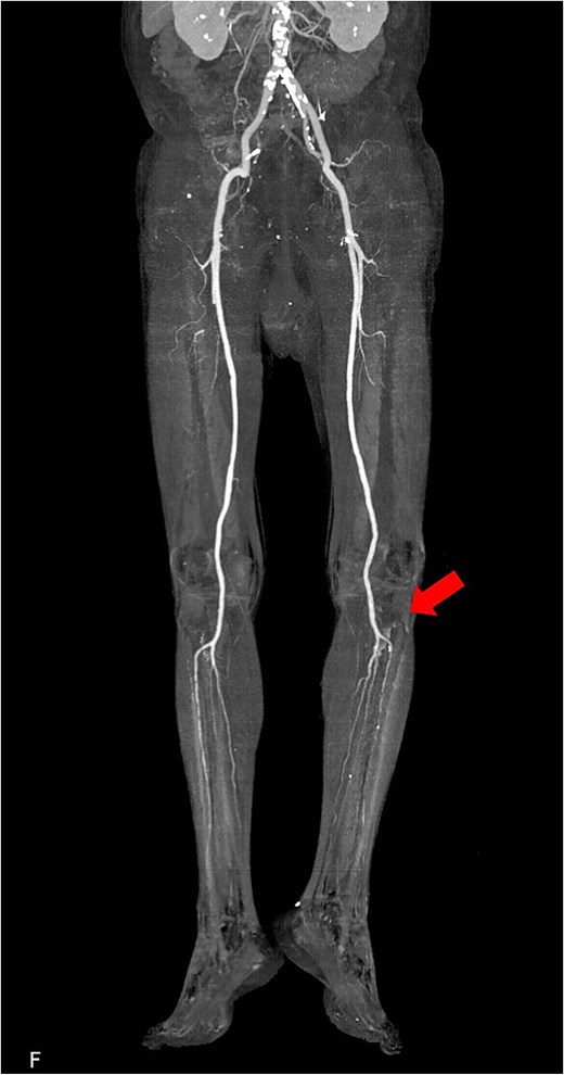 Postoperative 3D reconstructed contrast-enhanced CT. The contrast effect on lower limb blood flow is good.