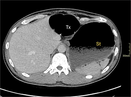 Axial CT image demonstrating distended transverse colon (Tx) and stomach (st).