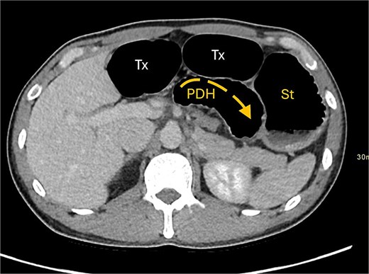 Axial CT image displaying transverse colon in paraduodenal hernia (PDH) with resulting distension of transverse colon (Tx) and stomach (st).