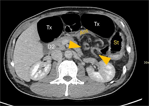 Gastric outflow obstruction of stomach (st) from compression of antrum (ant) by herniated transverse colon. Hernia between arrows.